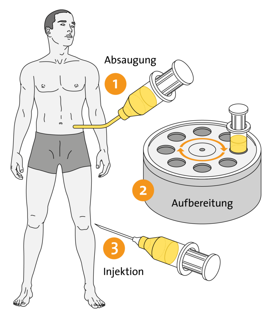 Schema SVF-Verfahren